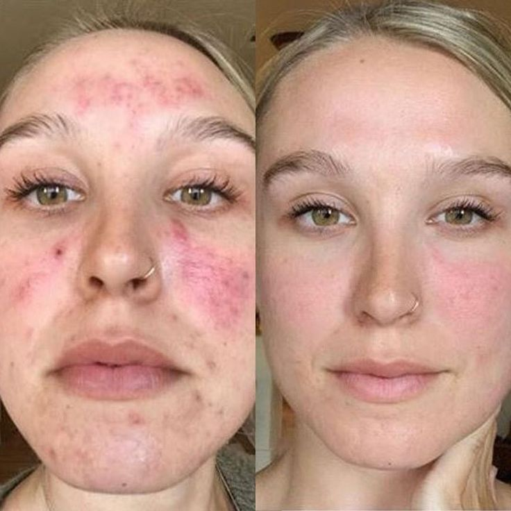 Face Reality: Acne Bootcamp real world result.