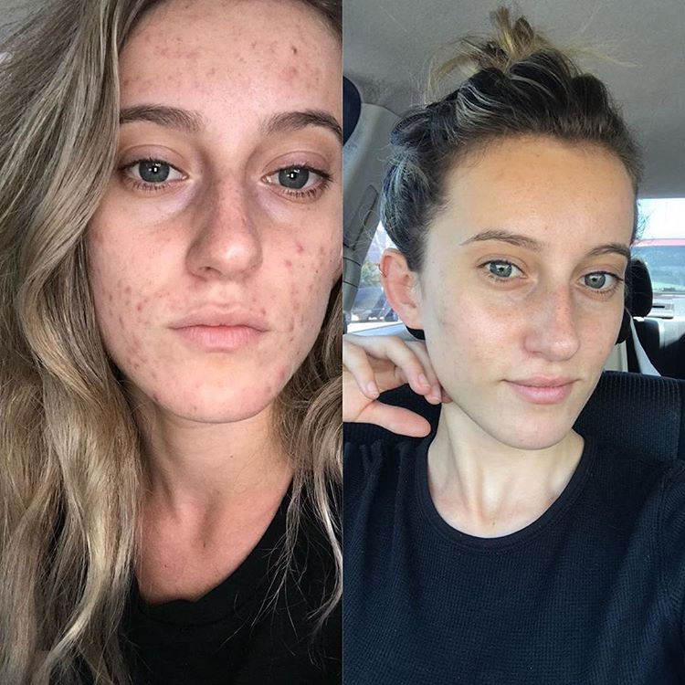 Face reality acne bootcamp before and after results